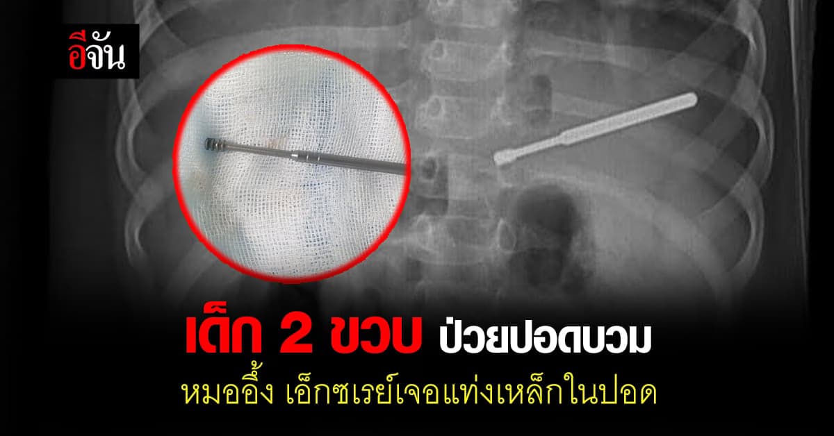หมอตะลึง เด็ก 2 ขวบ ป่วยปอดบวม เอ็กซเรย์เจอแท่งเหล็กในปอด