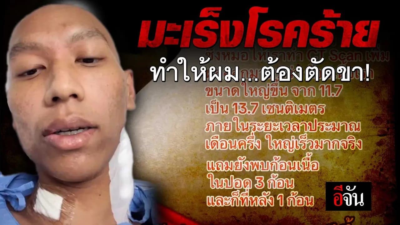 🎬 มะเร็งโรคร้าย ทำให้ผม…ต้องตัดขา!