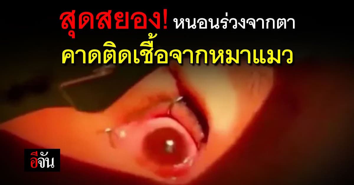 สุดสยอง! หมอคีบพยาธิออกจากตากว่า 60 ตัว คาดติดเชื้อจากหมาแมว