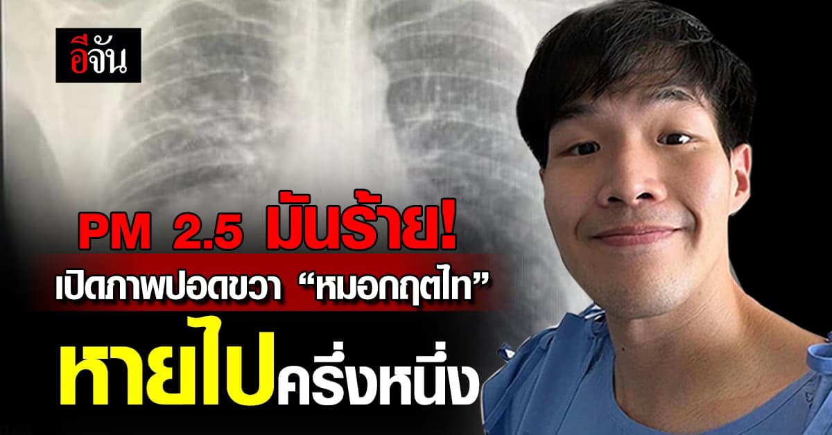 หมอแล็บแพนด้า โพสต์ภาพปอดขวา “หมอกฤตไท” หายไปครึ่งหนึ่ง
