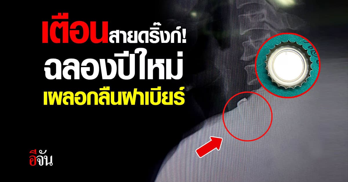 สายดริ๊งก์อย่าหาทำ! หนุ่มใหญ่ฉลองปีใหม่ เผลอกลืนฝาเบียร์ติดคอ