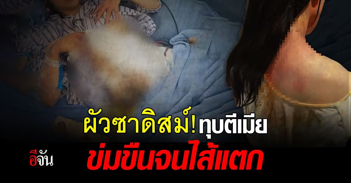 เกินคน! ผัวซาดิสม์ ทุบตีเมีย ข่มขืนจนไส้แตก สวมถุงอุจจาระไปตลอดชีวิต