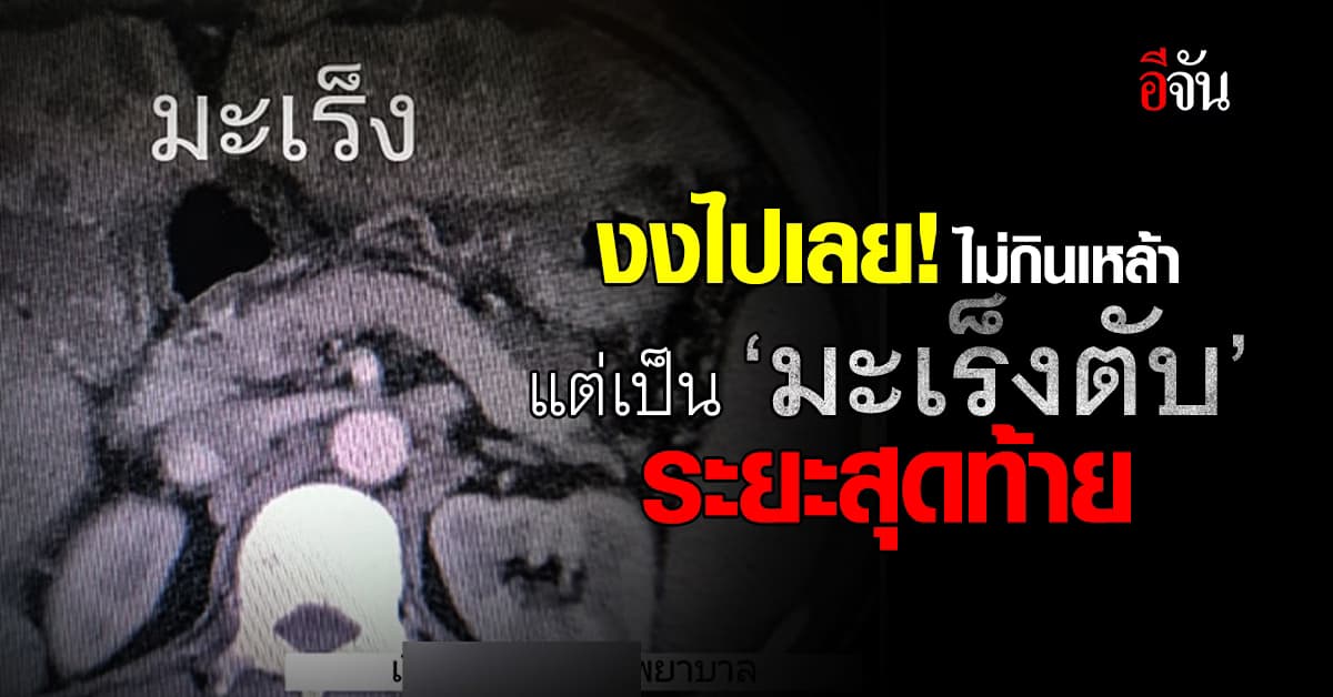 สะเทือนใจ! หนุ่ม 37 ไม่กินเหล้า-ออกกำลังกายประจำ แต่ป่วยมะเร็งตับ