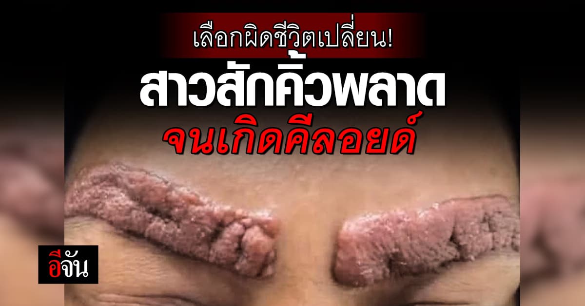 เลือกผิดชีวิตเปลี่ยน! สาวสักคิ้วพลาด จนเกิดคีลอยด์นูนเหมือนหมูกรอบ