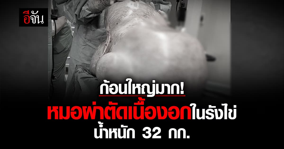 เบ้อเริ่ม! หมอเยอรมนีผ่าตัดเนื้องอกในรังไข่ น้ำหนัก 32 กก.