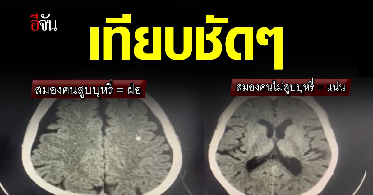 เทียบชัดๆ สมอง คนสูบบุหรี่ฝ่อ กับ คนไม่สูบบุหรี่แน่น