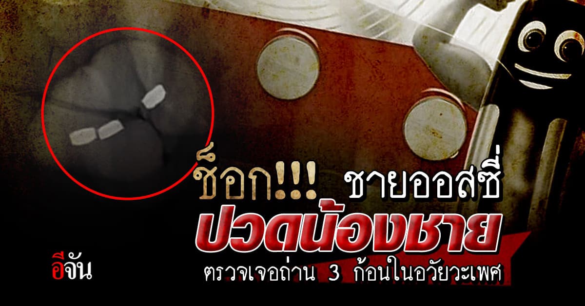 ชายวัย 73 ปวดน้องชาย ช็อก เจอถ่าน 3 ก้อน พร้อมเนื้อร้ายในอวัยวะเพศ