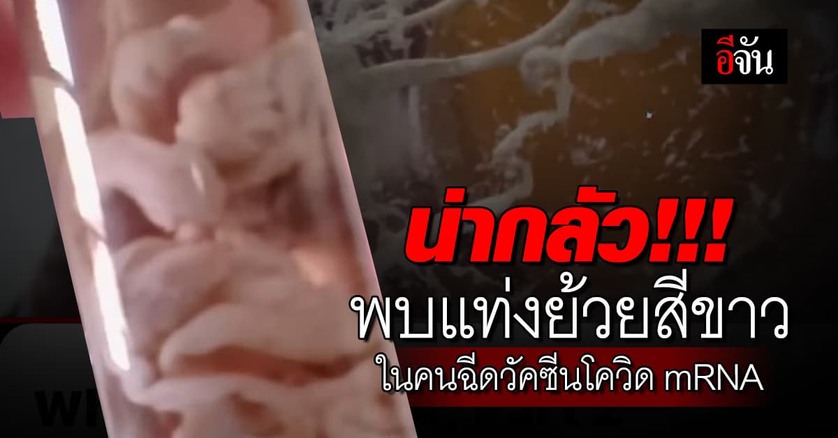 หมอธีระวัฒน์ เผยข้อมูล พบแท่งย้วยสีขาว ทำเส้นเลือดอุดตัน ในคนฉีดวัคซีนโควิด mRNA