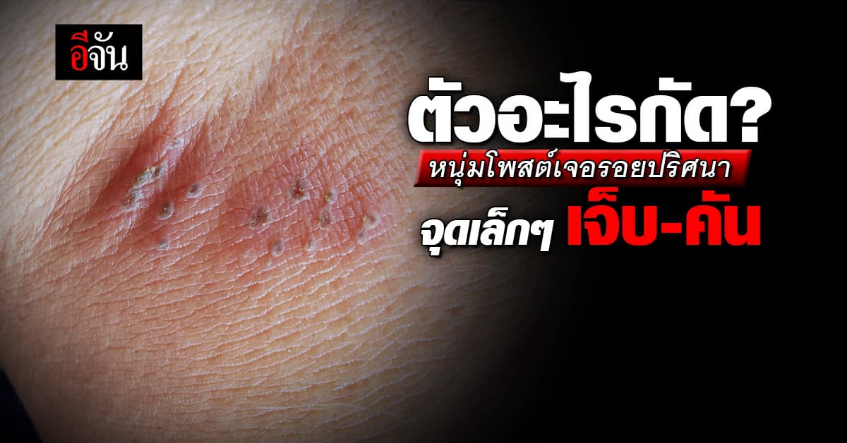 หนุ่มสงสัย โพสต์ถามโดนตัวอะไรกัด เจ็บ-คัน และเป็นจุดเล็กๆที่ผิวหนัง