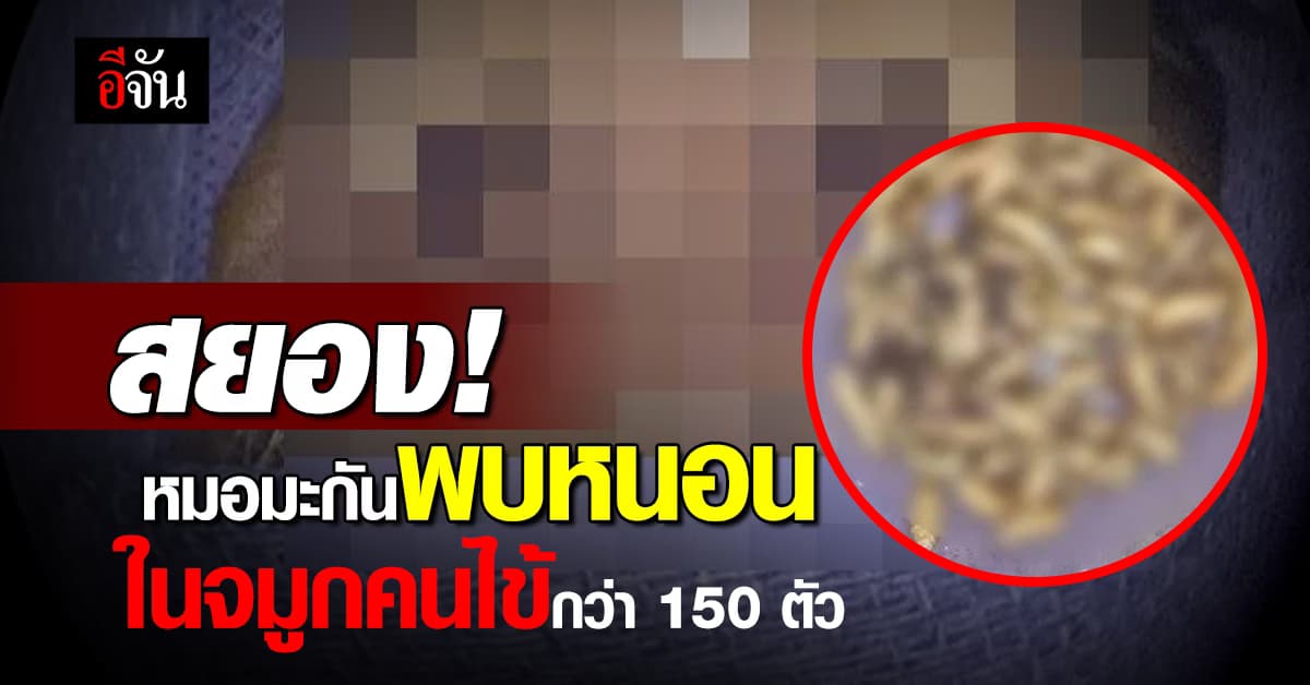 สยอง! หมอมะกันพบหนอนในจมูกคนไข้กว่า 150 ตัว