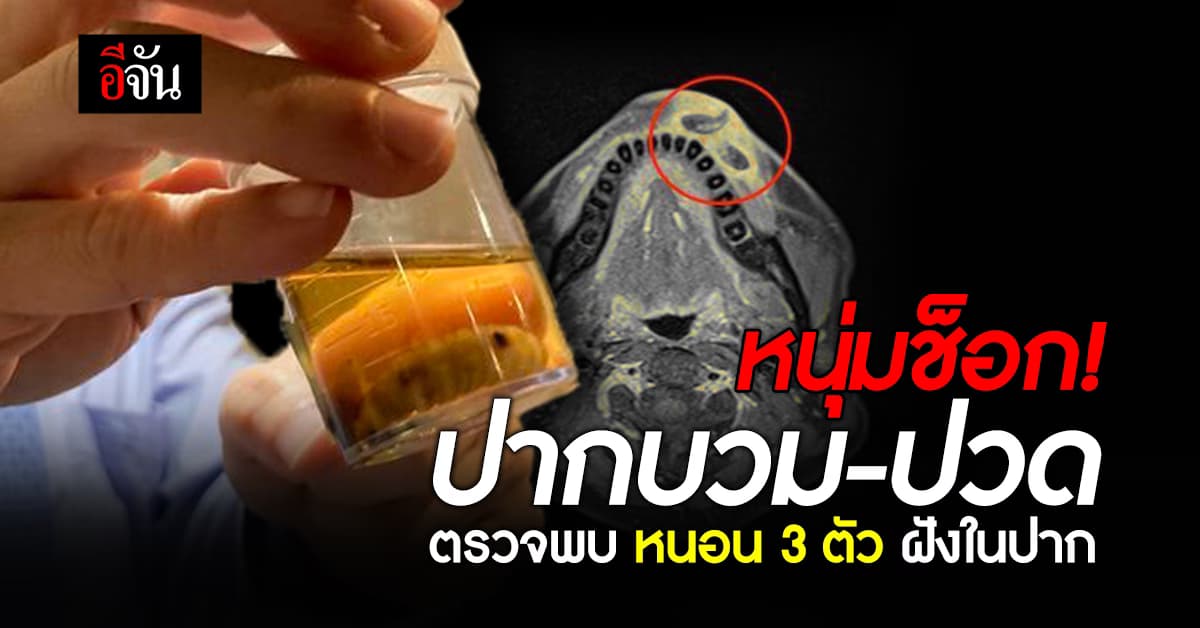 สยอง! หนุ่มปากบวม-ปวด ตรวจพบหนอน 3 ตัว ฝังในริมฝีปาก