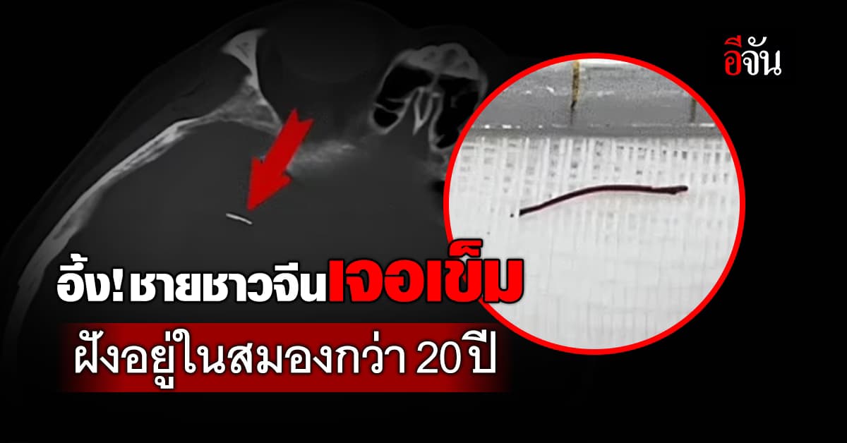  อึ้ง! ชายชาวจีน เจอเข็มฝังอยู่ในสมอง กว่า 20 ปี