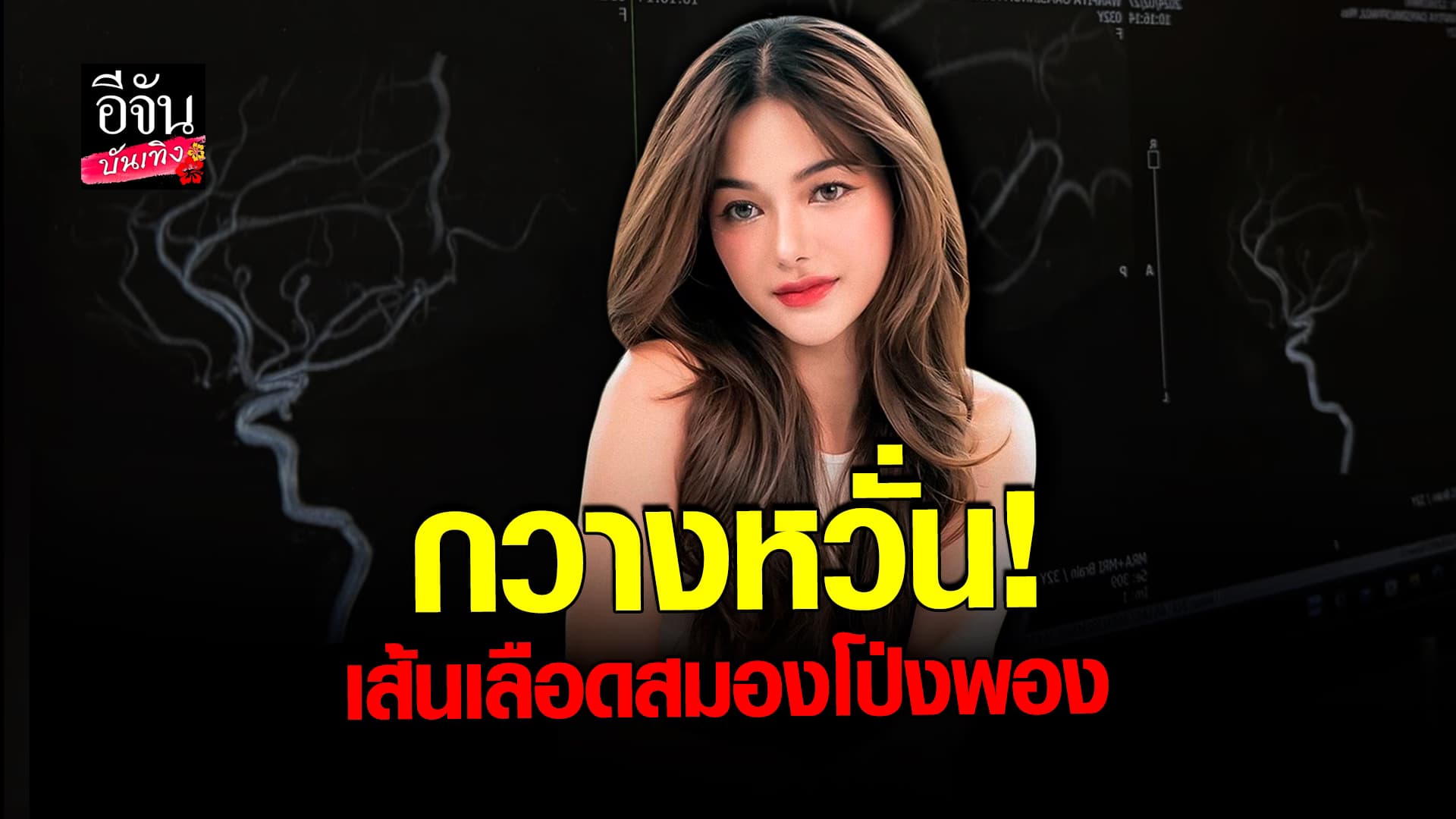 🎬 คลิปบันเทิง: กวาง วรรณปิยะ หวั่น เป็น โรคเส้นเลือดสมองโป่งพอง โล่งใจ เมื่อเห็นผลตรวจ