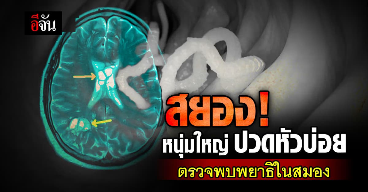 สยอง! หนุ่มใหญ่ ปวดหัวบ่อย ตรวจพบพยาธิยั้วเยี้ย วางไข่ในสมอง