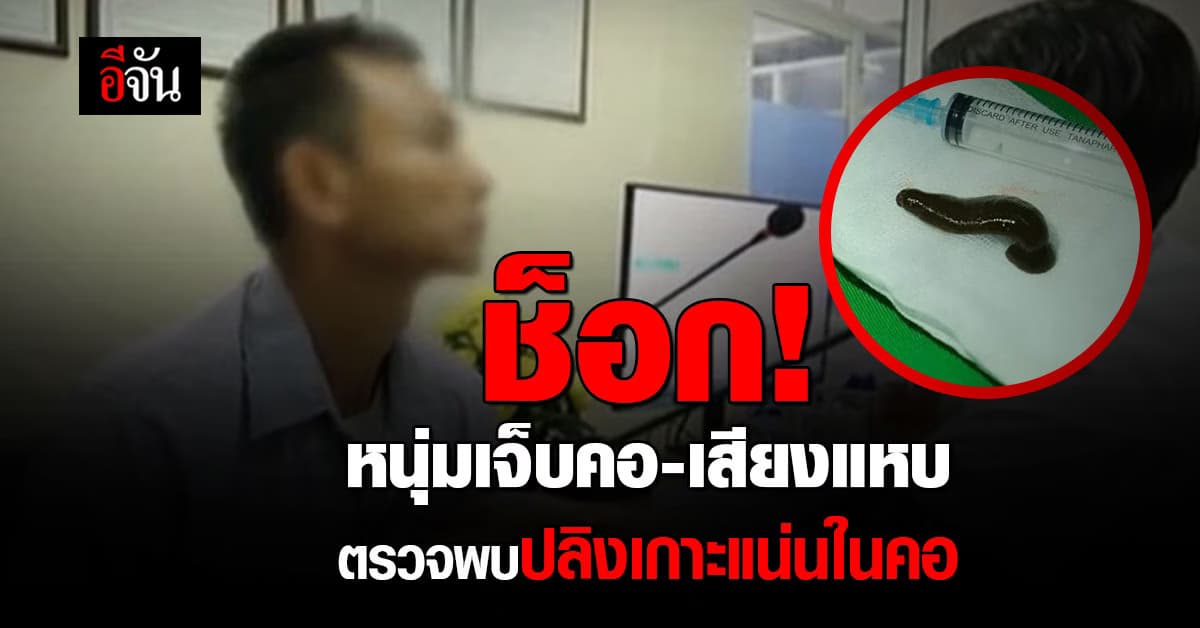 สุดช็อก! หนุ่มเจ็บคอ-เสียงแหบ ตรวจพบปลิง 6 ซม. เกาะแน่นในคอ