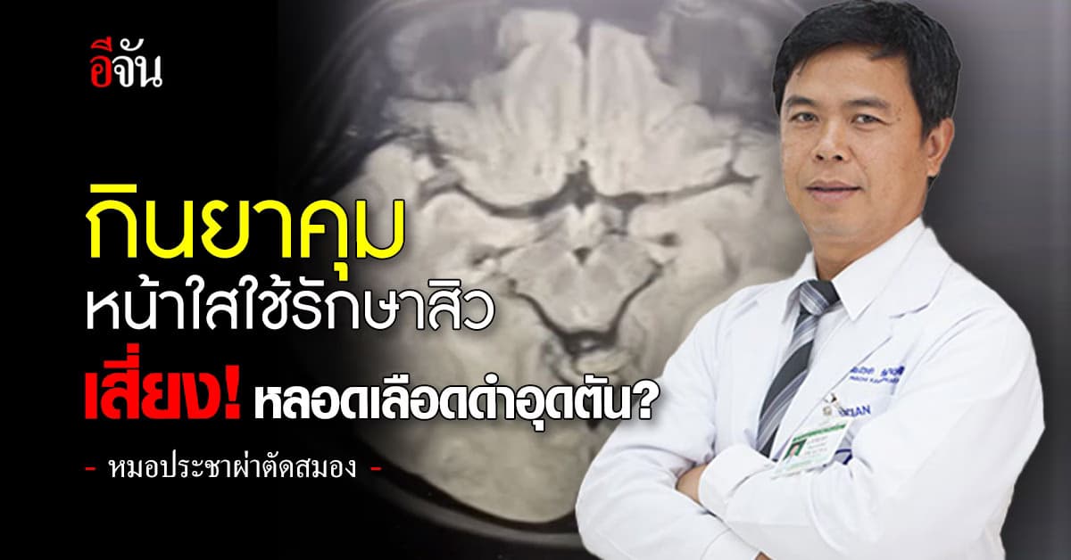 เตือน! กินยาคุมหน้าใสใช้รักษาสิว เสี่ยง! หลอดเลือดดำอุดตัน?