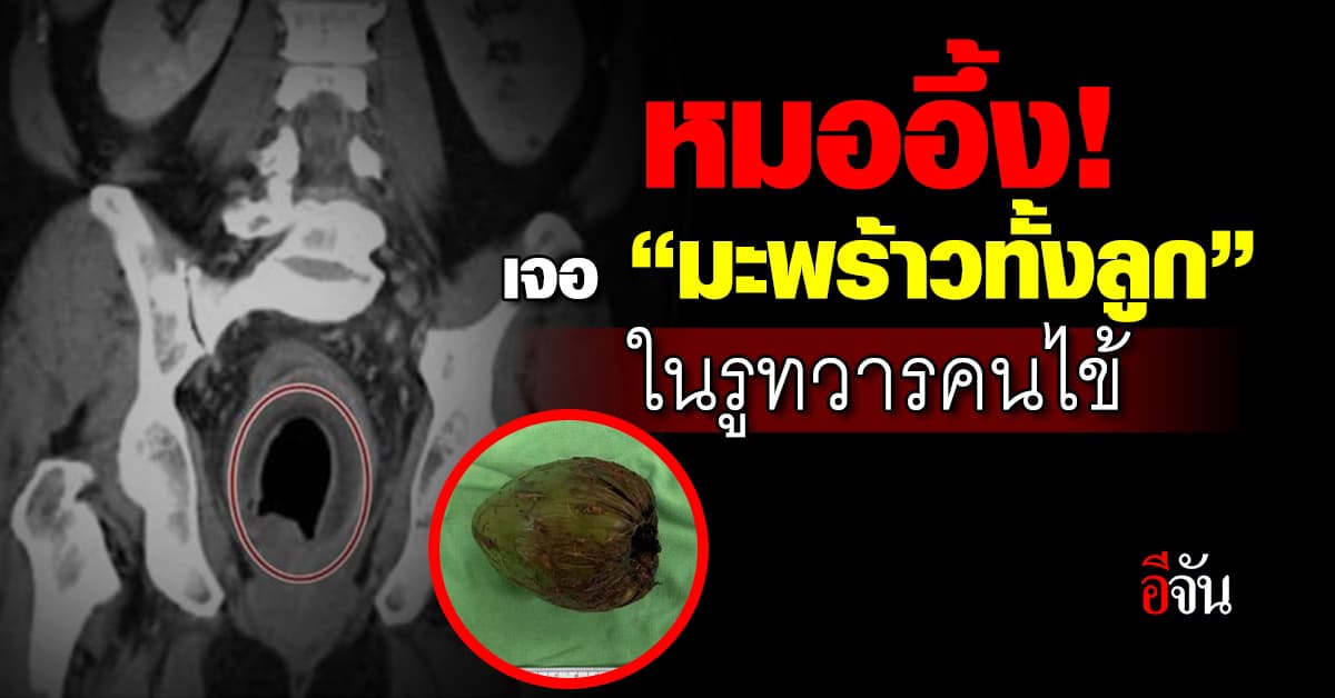 อึ้ง! ชายไต้หวันปัสสาวะลำบาก-ท้องผูกรุนแรง หมอตรวจเจอลูกมะพร้าวติดในรูทวาร 