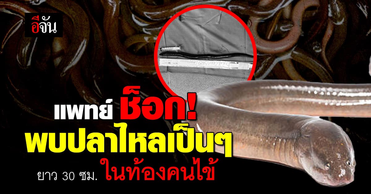 แพทย์ ช็อก! พบปลาไหลเป็นๆ ยาว 30 ซม. ในช่องท้องคนไข้