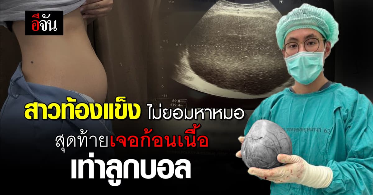 สาวเล่าอุทาหรณ์! ปวดท้องไม่ยอมหาหมอ สุดท้ายตรวจเจอก้อนเนื้อเท่าลูกบอล