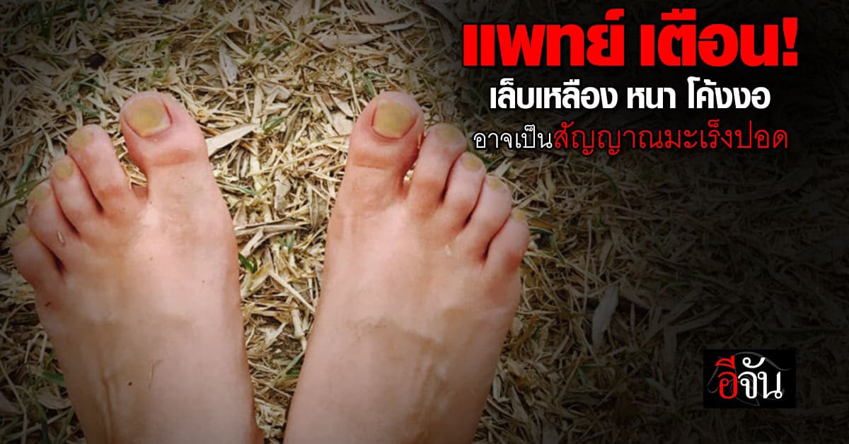 หมอเตือน! เล็บเหลือง หนาและโค้งงอ อาจเป็นสัญญาณเตือนมะเร็งปอด