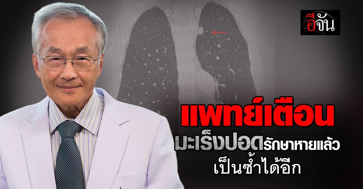 แพทย์ เตือน เคยป่วยมะเร็งปอดแต่รักษาหายแล้ว เป็นซ้ำได้อีก แนะเฝ้าระวังใกล้ชิด
