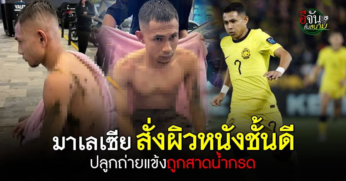 มาเลเซีย สั่งนำเข้าผิวหนังชั้นดี ช่วยชีวิตนักฟุตบอลถูกสาดน้ำกรด