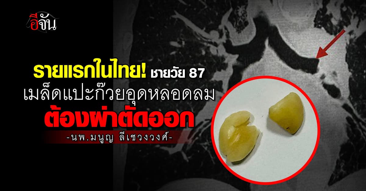 รายแรกในไทย! ชายวัย 87 เมล็ดแปะก๊วยอุดหลอดลม ต้องผ่าออก