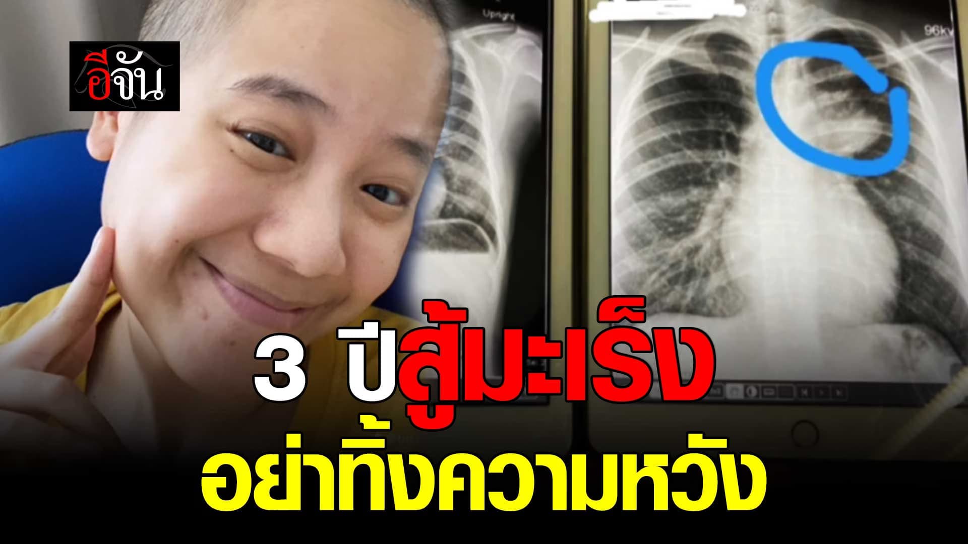 🎬 3 ปี สู้มะเร็ง อย่าทิ้งความหวัง