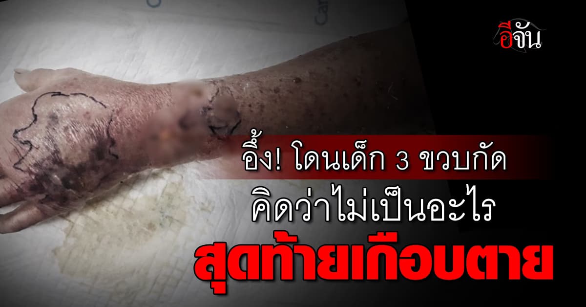 อึ้ง! โดนเด็ก 3 ขวบกัดคิดว่าไม่เป็นอะไร สุดท้ายเกือบตาย