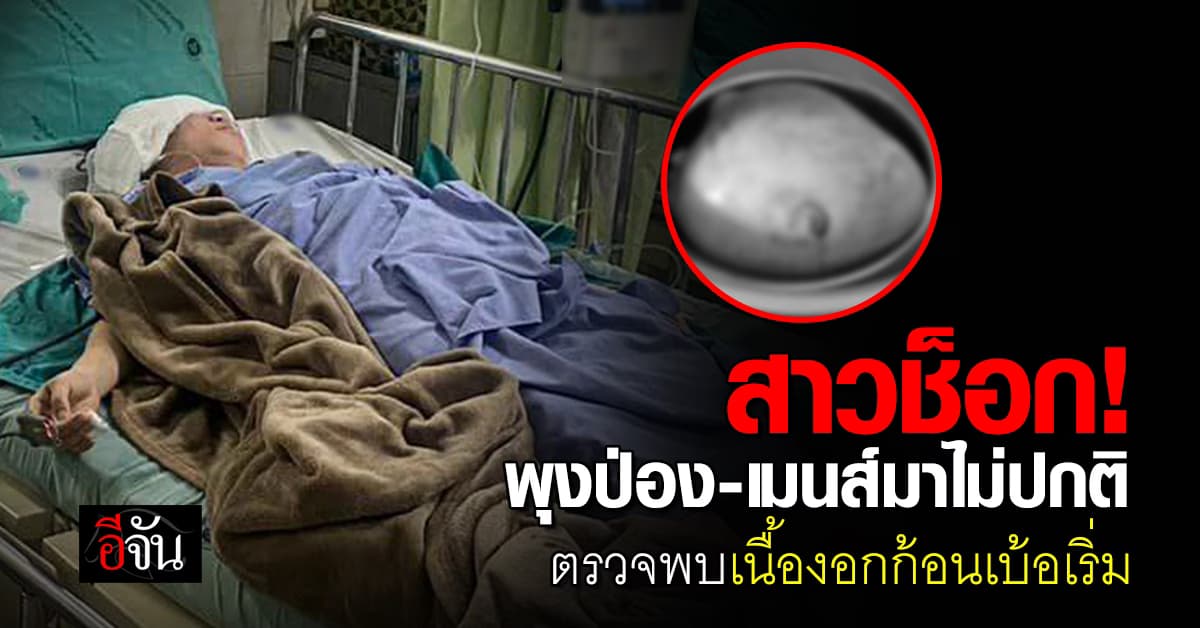 สาวสุดช็อก! นึกว่าแค่ลงพุง ที่แท้เป็นเนื้องอกในมดลูก ก้อนเท่ากะละมัง