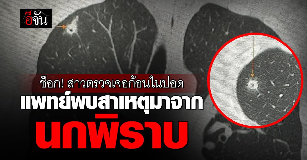 หมอมนูญเตือน อยู่ห่าง นกพิราบ หลังพบทำสาววัย 52 ปอดอักเสบ 