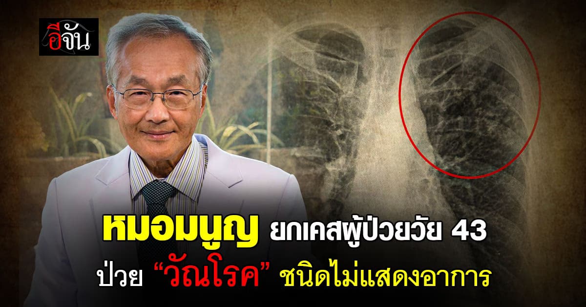 หมอมนูญ ยกเคสผู้ป่วยวัย 43 ปี ป่วย “วัณโรค” ชนิดไม่แสดงอาการ
