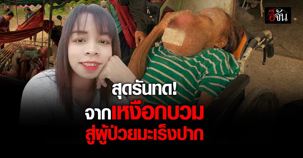 สุดรันทด! สาวป่วยมะเร็งปาก เผย แรก ๆ มีอาการคล้ายเหงือกบวม  