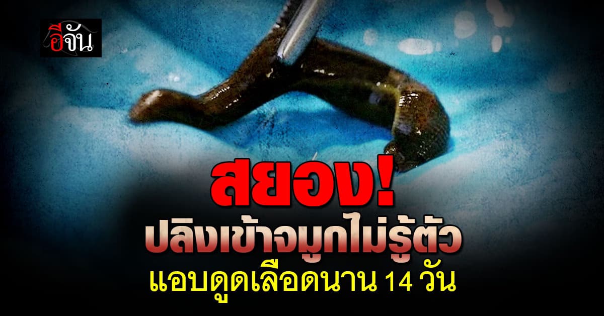 สยอง ปลิงเข้าจมูกชายอินเดียนาน 14 วัน กว่าจะรู้ตัว 