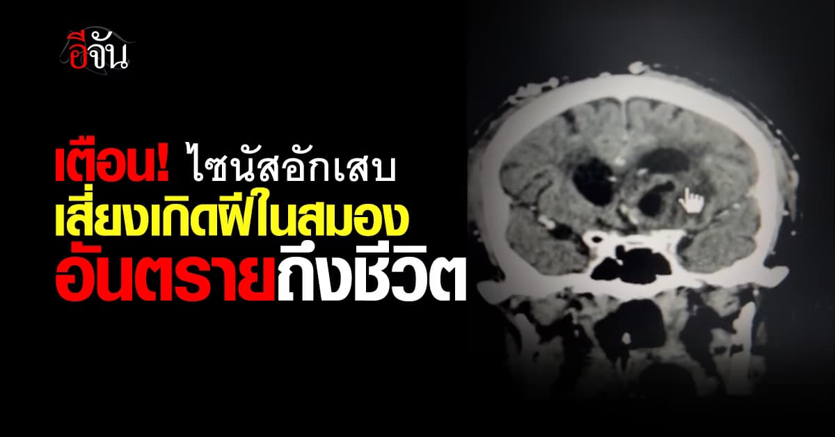 เตือน! ไซนัสอักเสบ เสี่ยงเกิดฝีในสมอง อันตรายถึงชีวิต