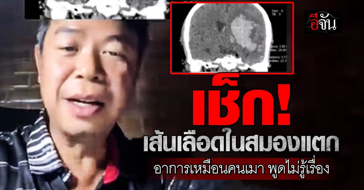 เช็ก! เส้นเลือดในสมองแตก อาการเหมือนคนเมา พูดไม่รู้เรื่อง