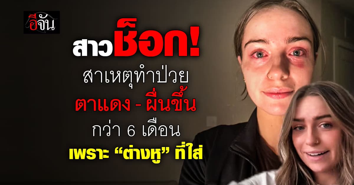 สาวช็อก! สาเหตุทำป่วยตาแดง-ผื่นขึ้นกว่า 6 เดือน เพราะ “ต่างหู” ที่ใส่