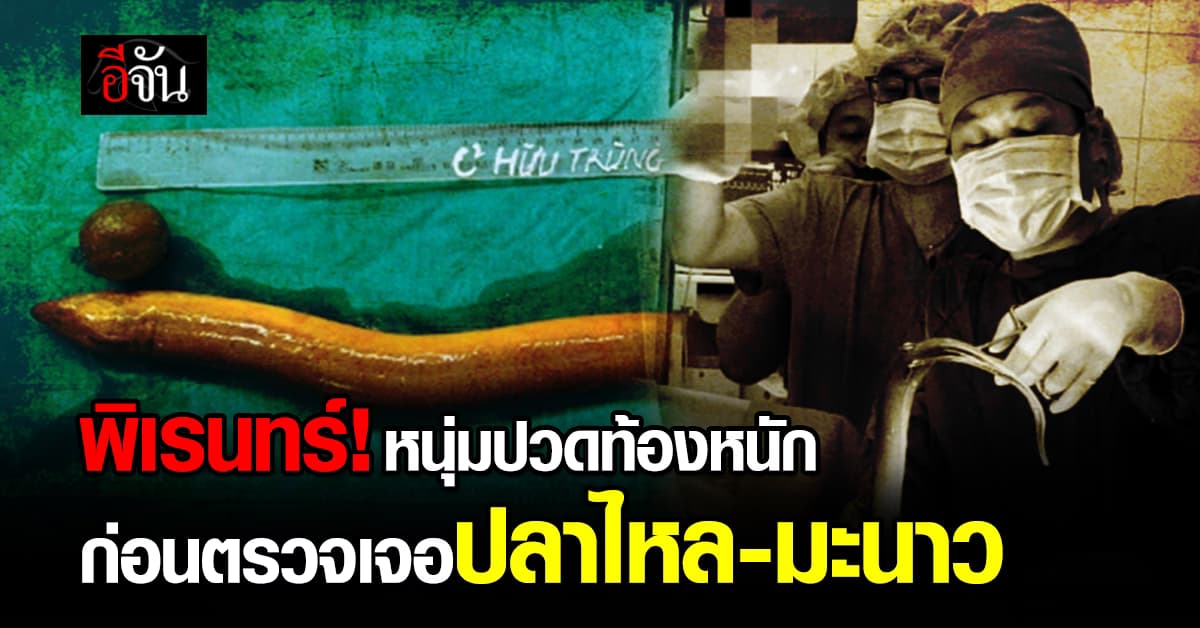 หนุ่มวัย 31 ปี ปวดท้องหนัก ก่อนตรวจเจอปลาไหลในท้อง มะนาวในทวาร