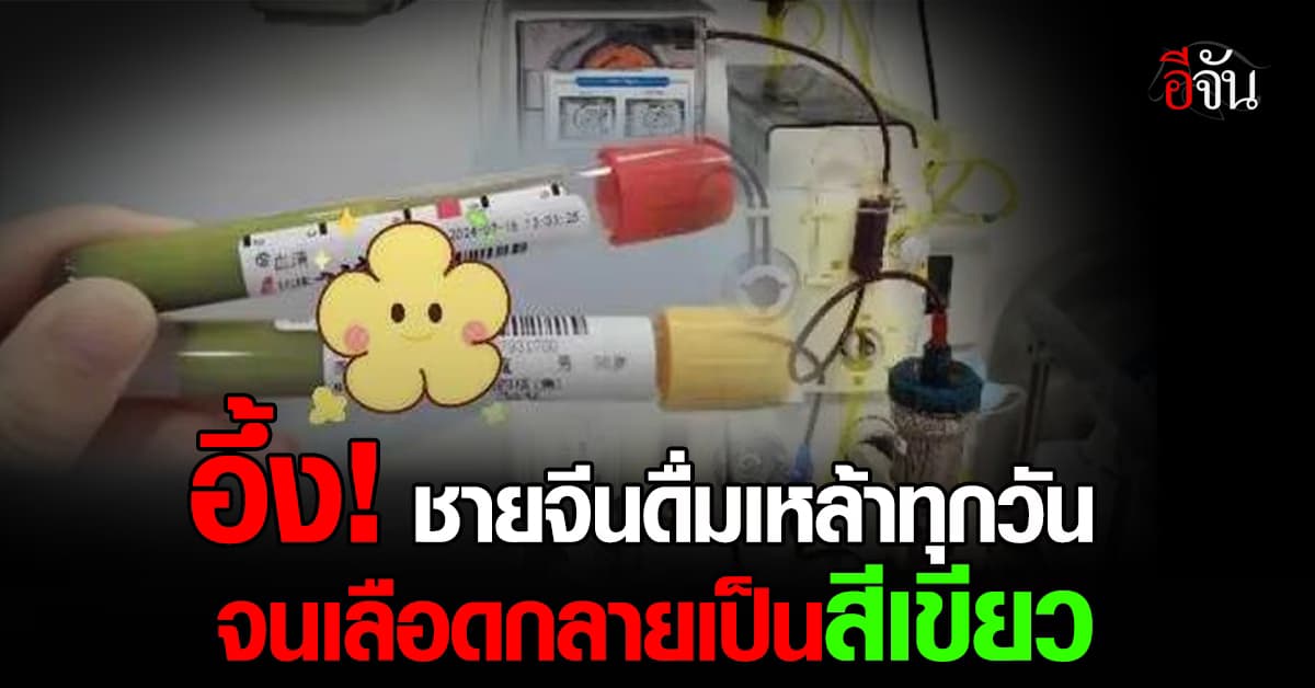 อุทาหรณ์นักดื่ม! ชายจีนวัย 36 เกือบตาย เพราะดื่มเหล้าทุกวันจนเลือดเป็นสีเขียว