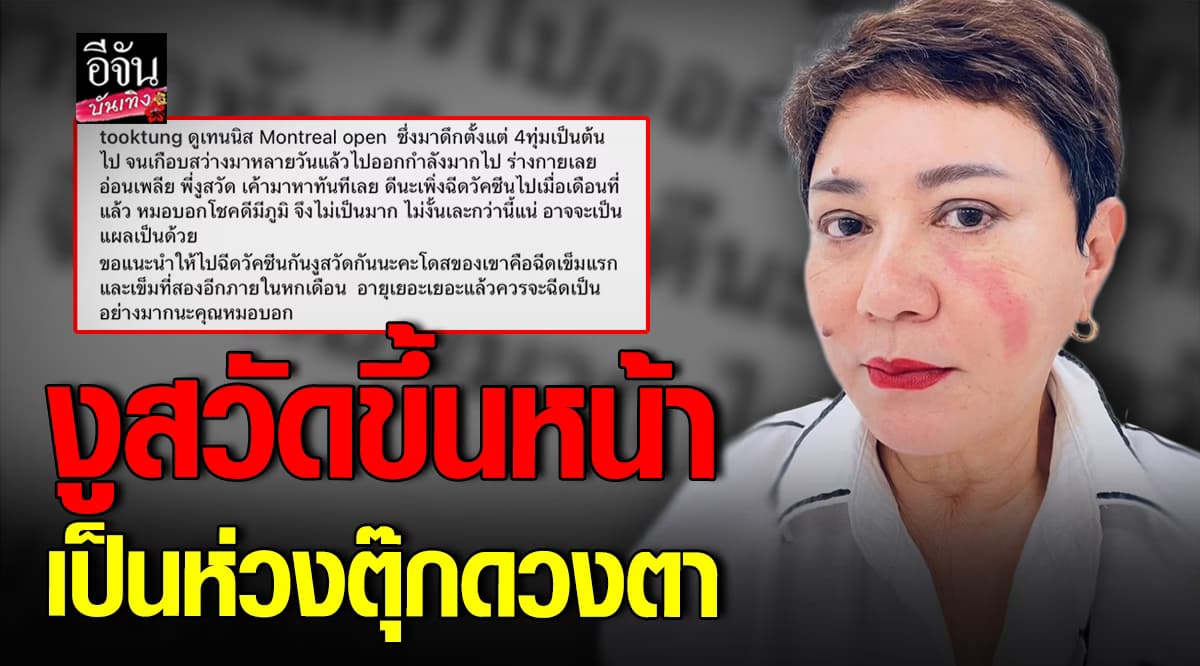 ตุ๊ก ดวงตา เผยสาเหตุ งูสวัด ขึ้นหน้า พร้อมแชร์วิธีรักษา