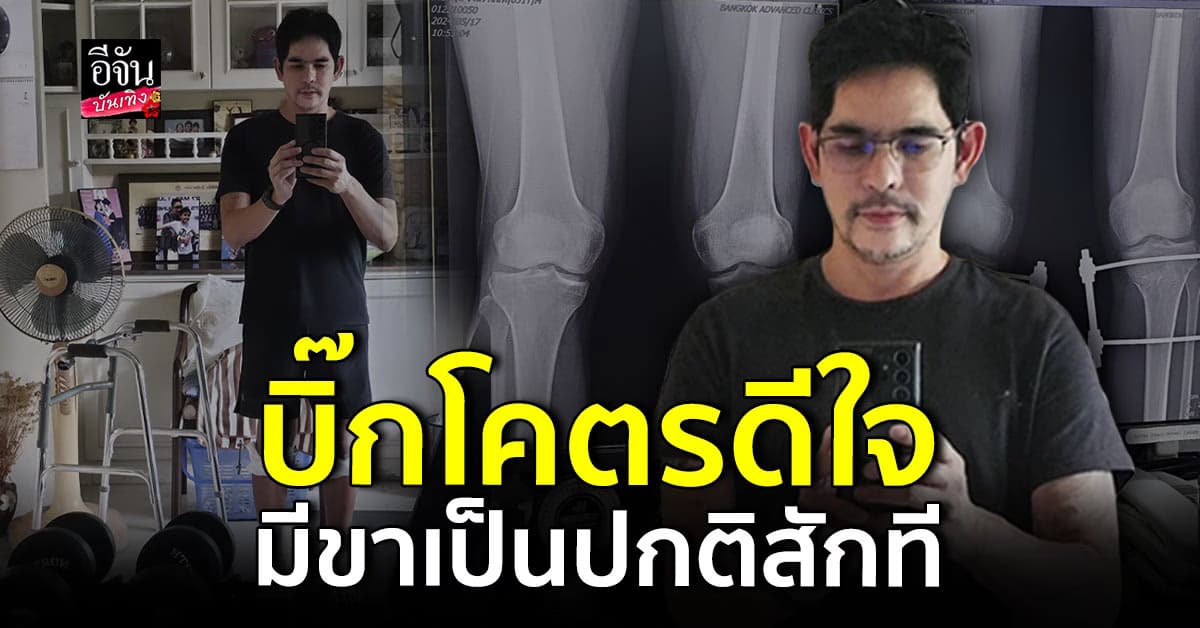 บิ๊ก ศรุต อัปเดตขา หลังผ่าตัดได้ 2 เดือน