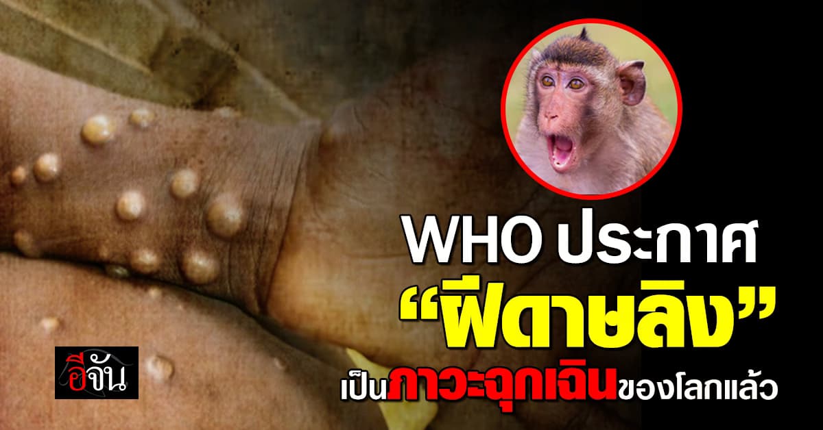 องค์การอนามัยโลก ประกาศ “ฝีดาษลิง” เป็นภาวะฉุกเฉินของโลกแล้ว