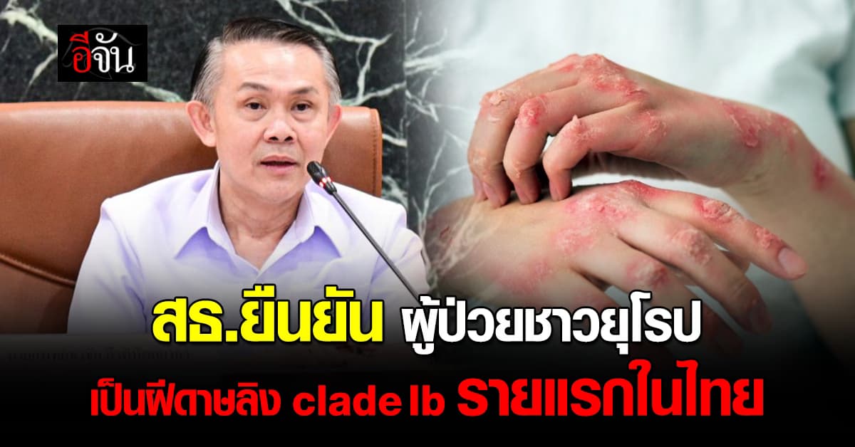 สธ.ยืนยัน ผู้ป่วยชาวยุโรปเป็นฝีดาษลิง clade Ib รายแรกในไทย