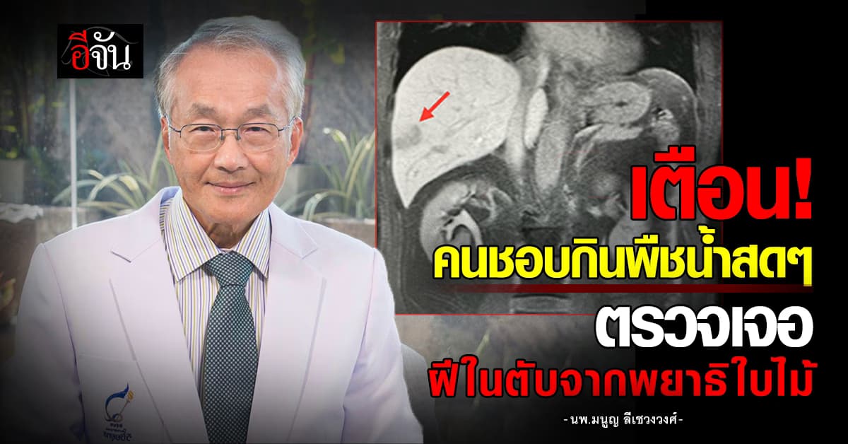 เตือนคนชอบกินพืชน้ำสด! หมอมนูญ ตรวจเจอผู้ป่วยฝีในตับจากพยาธิใบไม้
