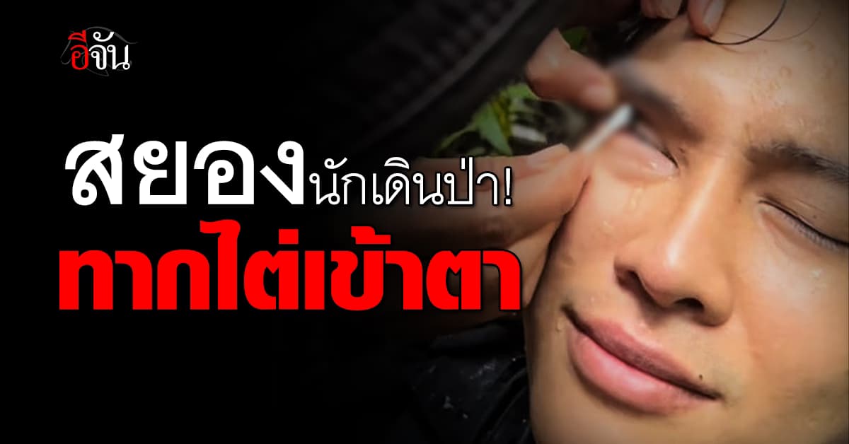 สุดสยอง นักเดินป่าคิดว่าฝุ่นเข้าตา ก่อนช็อกหนักเจอทากอยู่ในตา