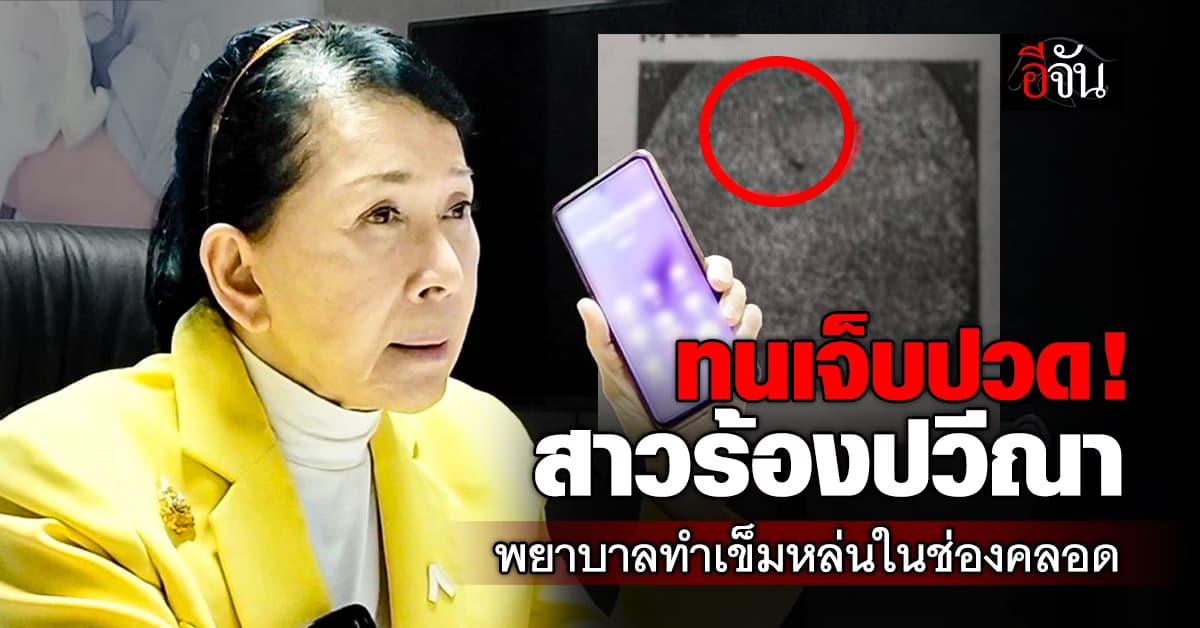 สาวนราฯ ปวดท้องทรมาน ตรวจเจอเข็มในช่องคลอด ค้างนาน 18 ปี