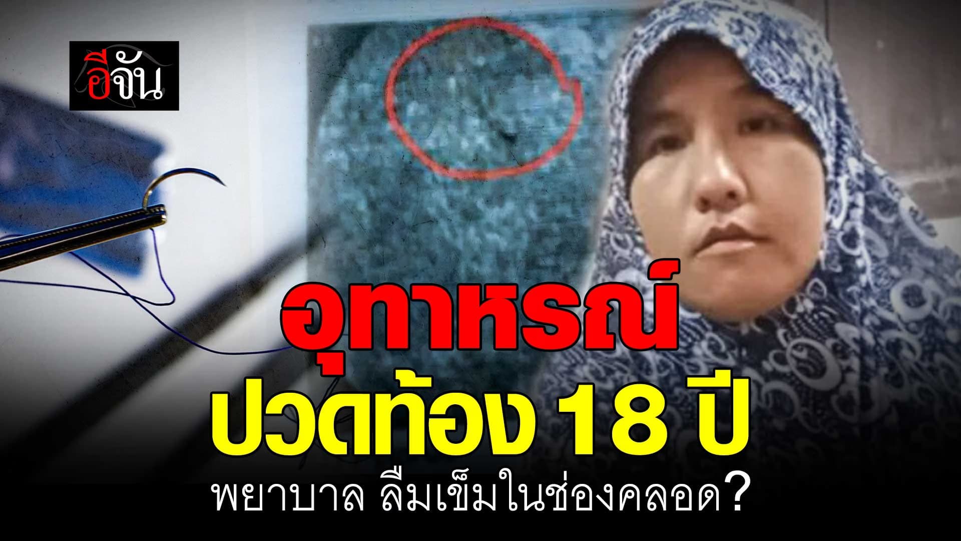 🎬 อุทาหรณ์ ปวดท้อง 18 ปี พยาบาล ลืมเข็มในช่องคลอด?