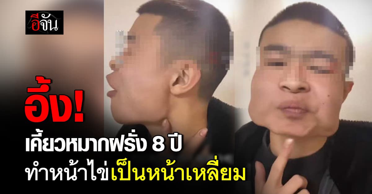 อึ้ง! หนุ่มจีนเผยวิวัฒนาการ “เคี้ยวหมากฝรั่ง 8 ปี” เปลี่ยนรูปหน้าไปตลอดกาล