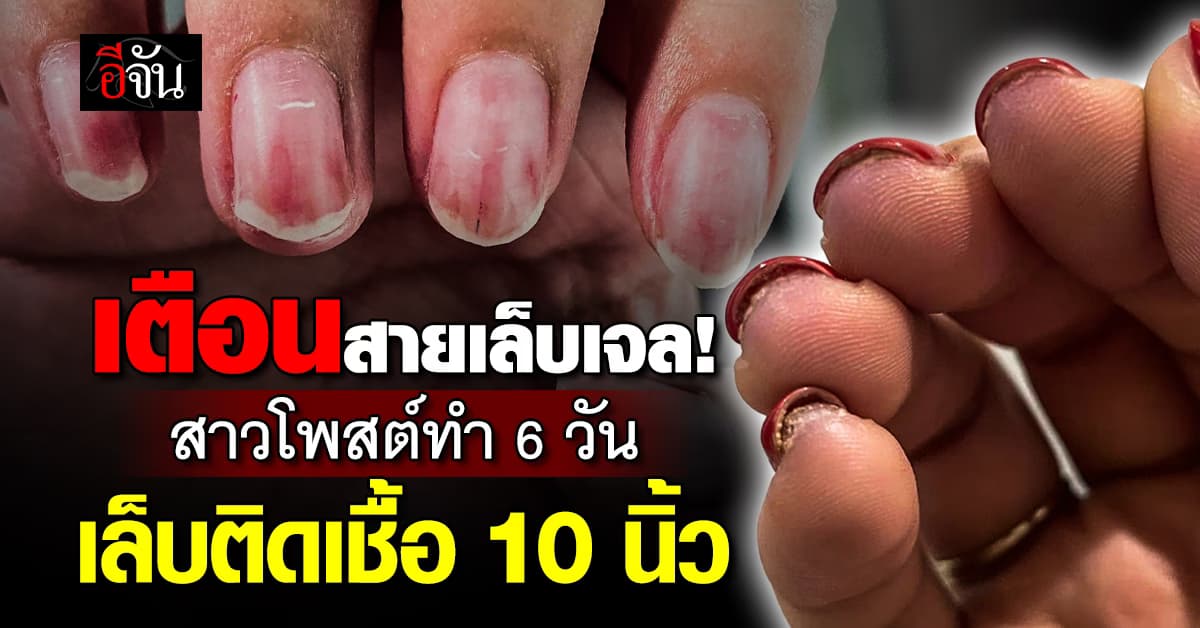 เตือนภัย! สาวโพสต์ทำเล็บเจลติดเชื้อ 10 นิ้ว ร้านบอกหายดีให้ทำฟรี 1 เดือน