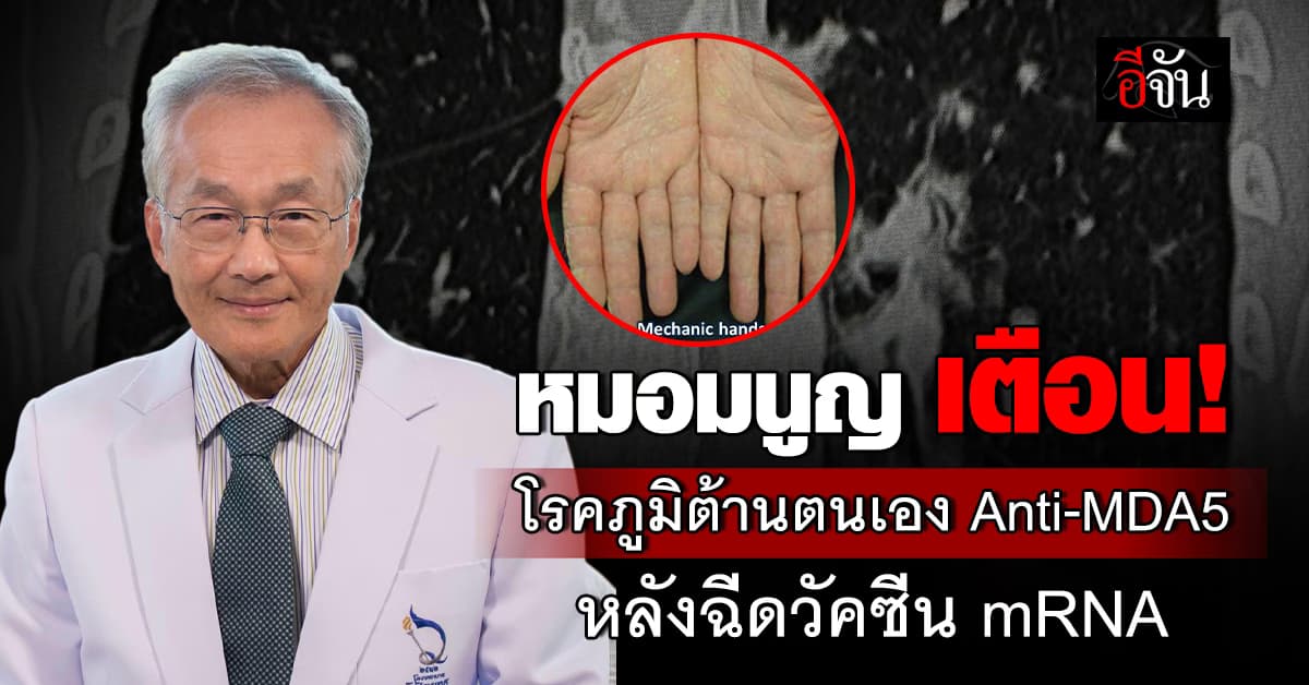 หมอมนูญ เตือน! โรคภูมิต้านตนเอง Anti-MDA5 หลังฉีดวัคซีน mRNA